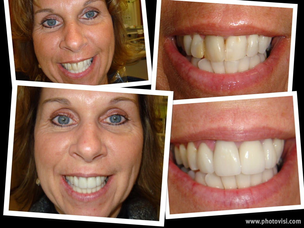 Crowns Before & After - Advanced Dental Care Quincy, IL