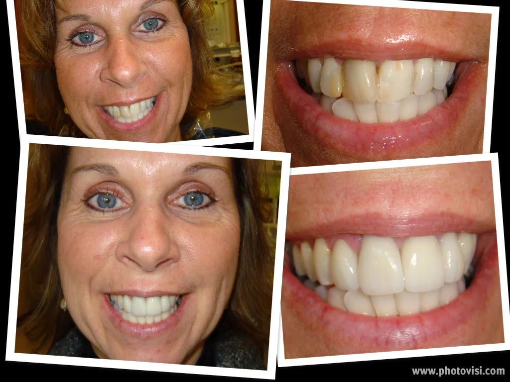 collage-II Crowns Before & After - Advanced Dental Care Quincy, IL