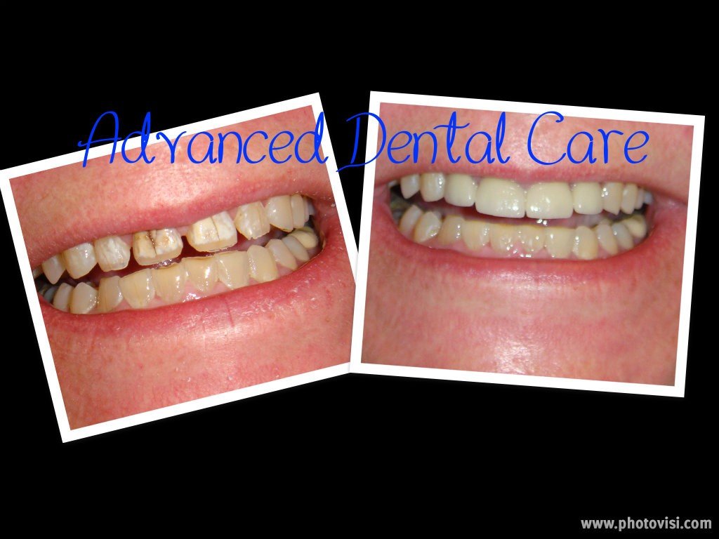 collage Before & After - Advanced Dental Care Quincy, IL
