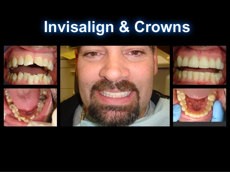 Invisalign Before & After - Advanced Dental Care Quincy, IL