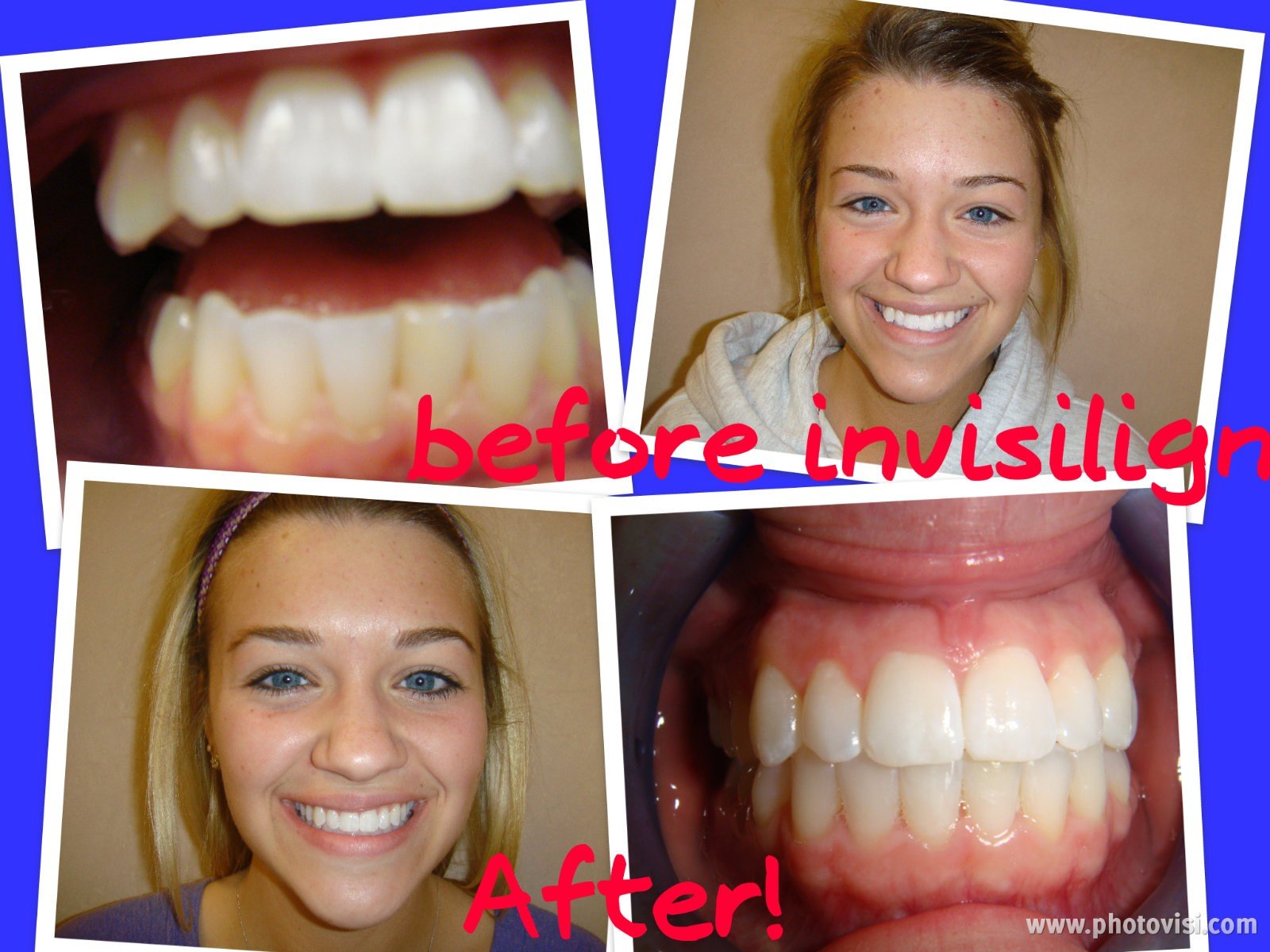 Invisalign Before & After - Advanced Dental Care Quincy, IL