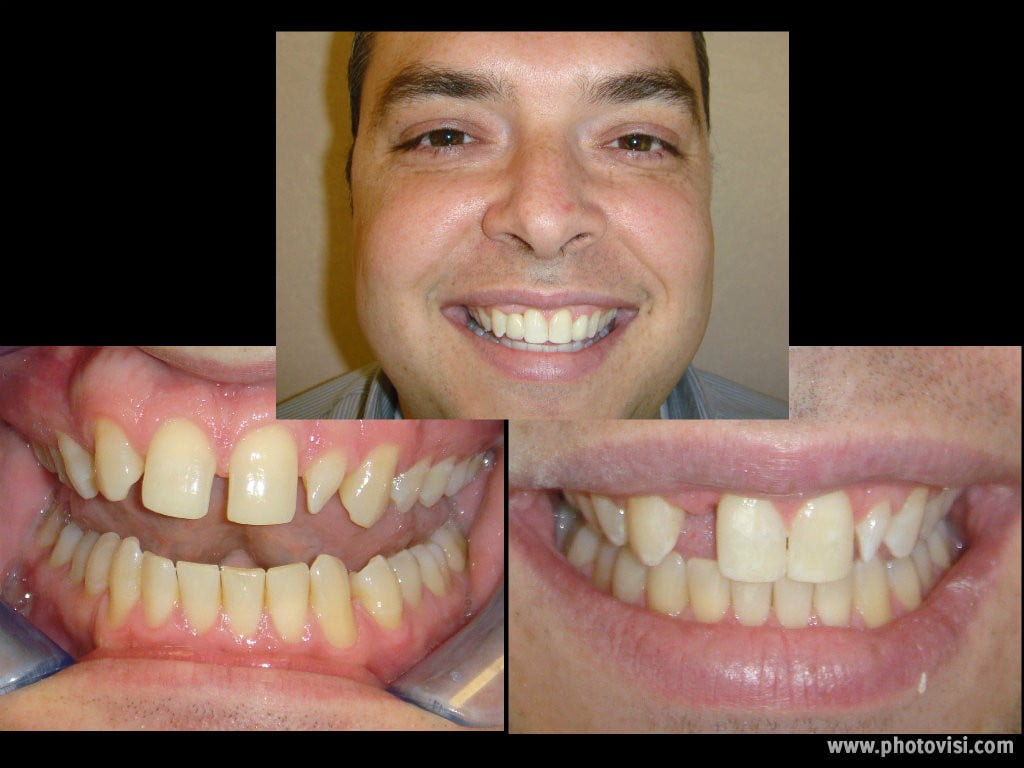 Invisalign Before & After - Advanced Dental Care Quincy, IL