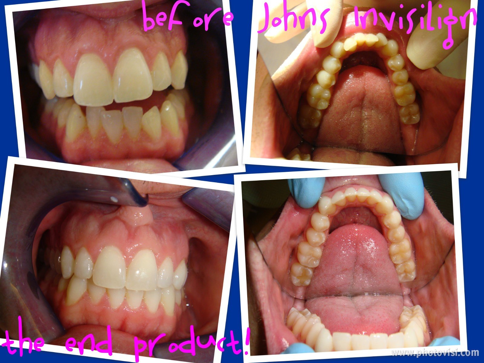 Invisalign Before & After - Advanced Dental Care Quincy, IL