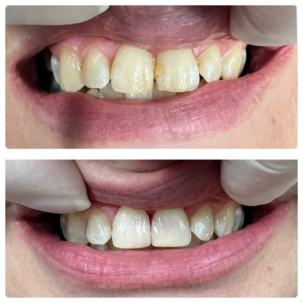 Before & After - Restorative Dentistry