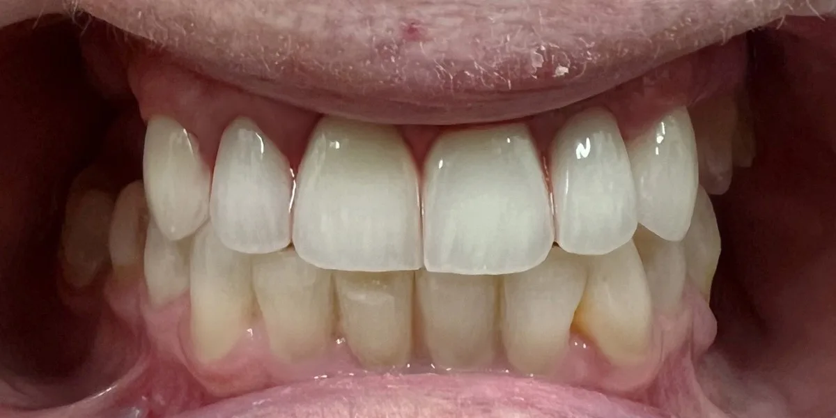 After Restorative Dentistry - Patient 007