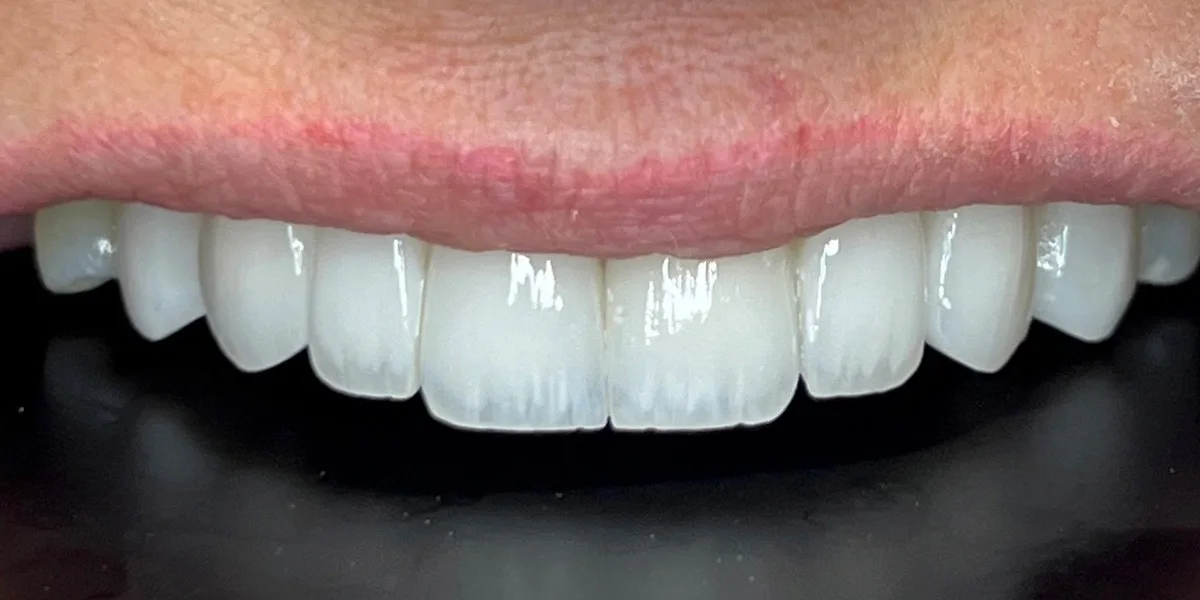 After Restorative Dentistry - Patient 008
