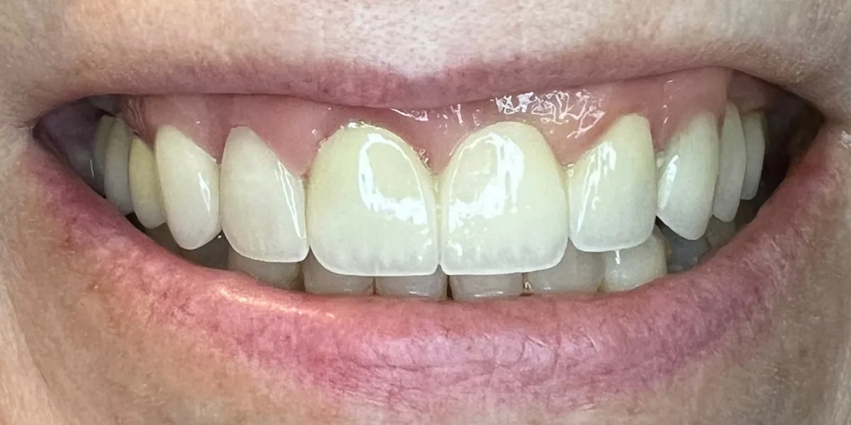 After Restorative Dentistry - Patient 009